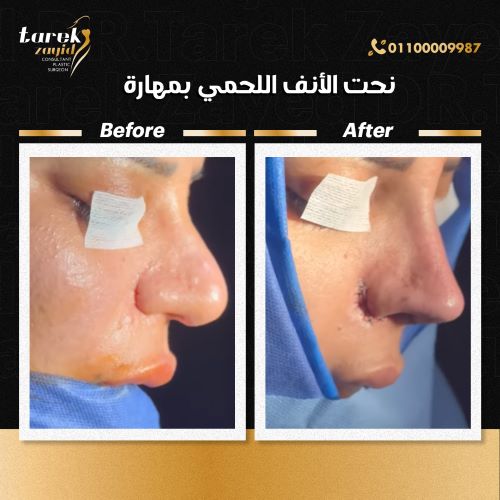 دكتور طارق زايد افضل دكتور تجميل انف في مصر